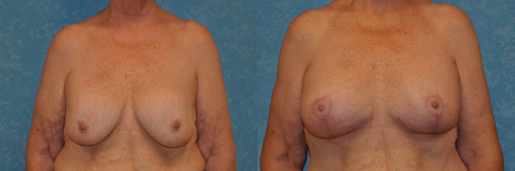 Before & After Breast Lift With Implants Case 390 Front View in Toledo, Ohio