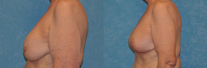 Before & After Breast Lift With Implants Case 390 Left Side View in Toledo, Ohio