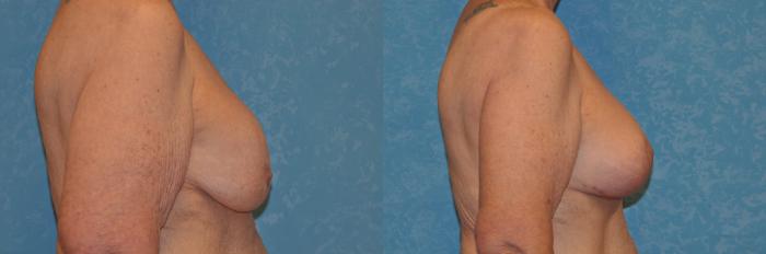 Before & After Breast Lift With Implants Case 390 Right Side View in Toledo, Ohio