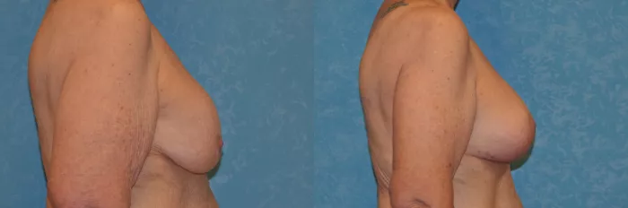 Breast Lift With Implants Before and After Pictures Case 390