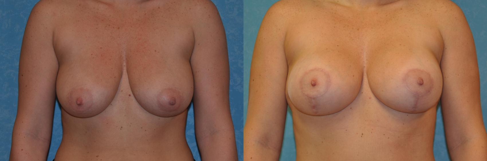 Before & After Breast Lift With Implants Case 419 Front View in Toledo, Ohio
