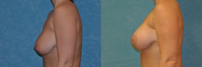 Before & After Breast Augmentation Case 419 Left Side View in Toledo, Ohio