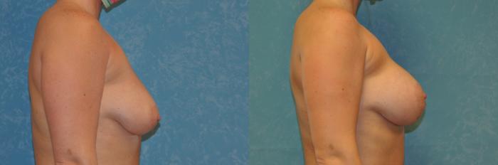 Before & After Breast Augmentation Case 419 Right Side View in Toledo, Ohio
