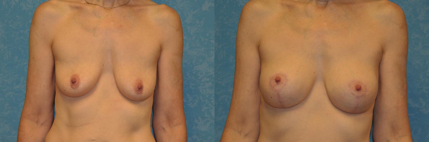 Before & After Breast Lift With Implants Case 423 Front View in Toledo, Ohio