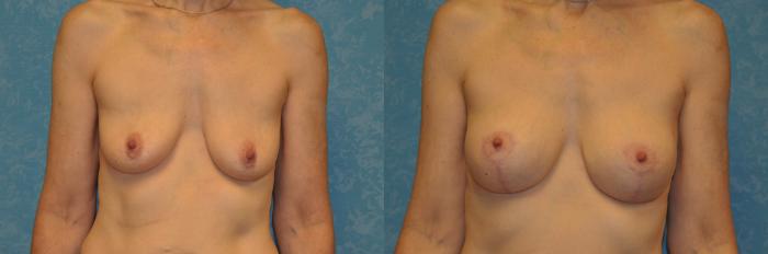Before & After Breast Lift With Implants Case 423 Front View in Toledo, Ohio