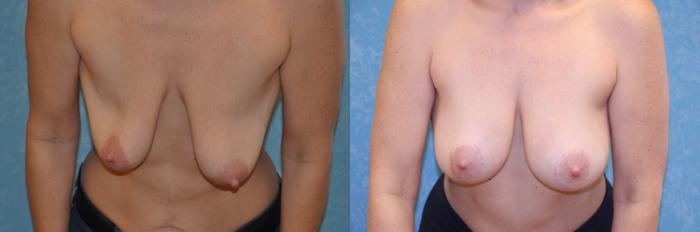 Before & After Breast Lift With Implants Case 433 Bent Forward View in Toledo, Ohio