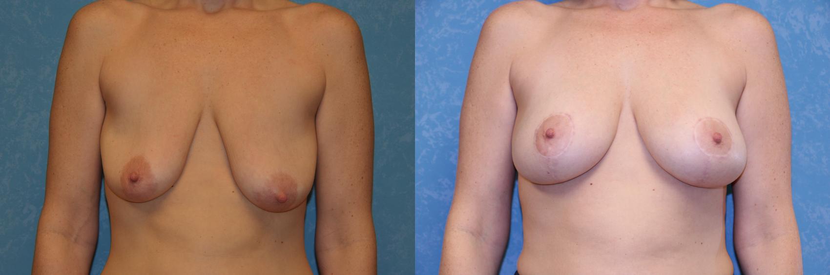 Before & After Breast Lift With Implants Case 433 Front View in Toledo, Ohio