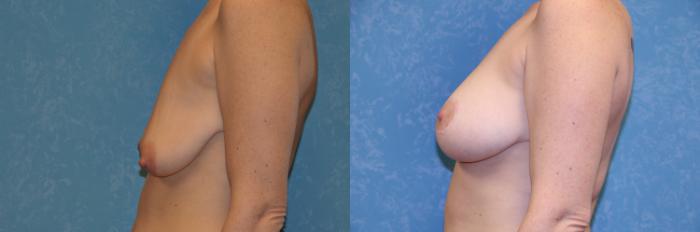 Before & After Breast Lift With Implants Case 433 Left Side View in Toledo, Ohio