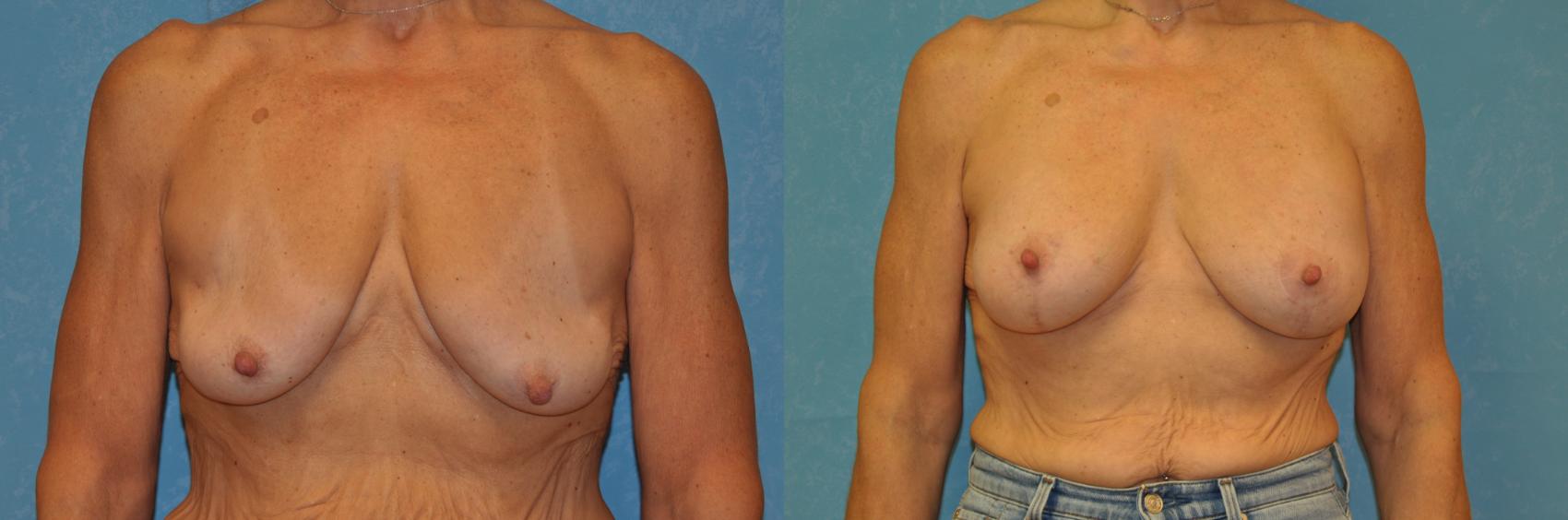 Before & After Breast Lift With Implants Case 438 Front View in Toledo, Ohio