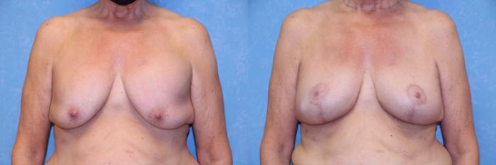 Before & After Breast Lift With Implants Case 463 Front View in Toledo, Ohio