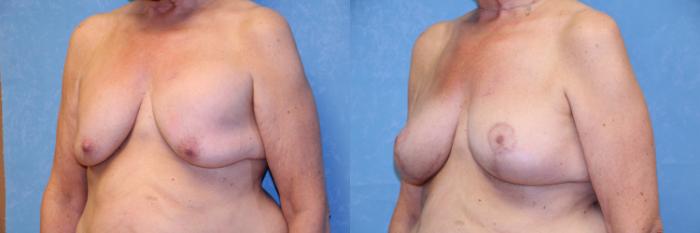 Before & After Breast Lift With Implants Case 463 Left Oblique View in Toledo, Ohio