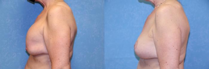 Before & After Breast Lift With Implants Case 463 Left Side View in Toledo, Ohio