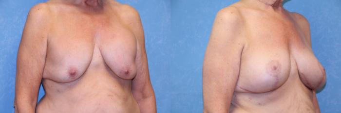 Before & After Breast Lift With Implants Case 463 Right Oblique View in Toledo, Ohio