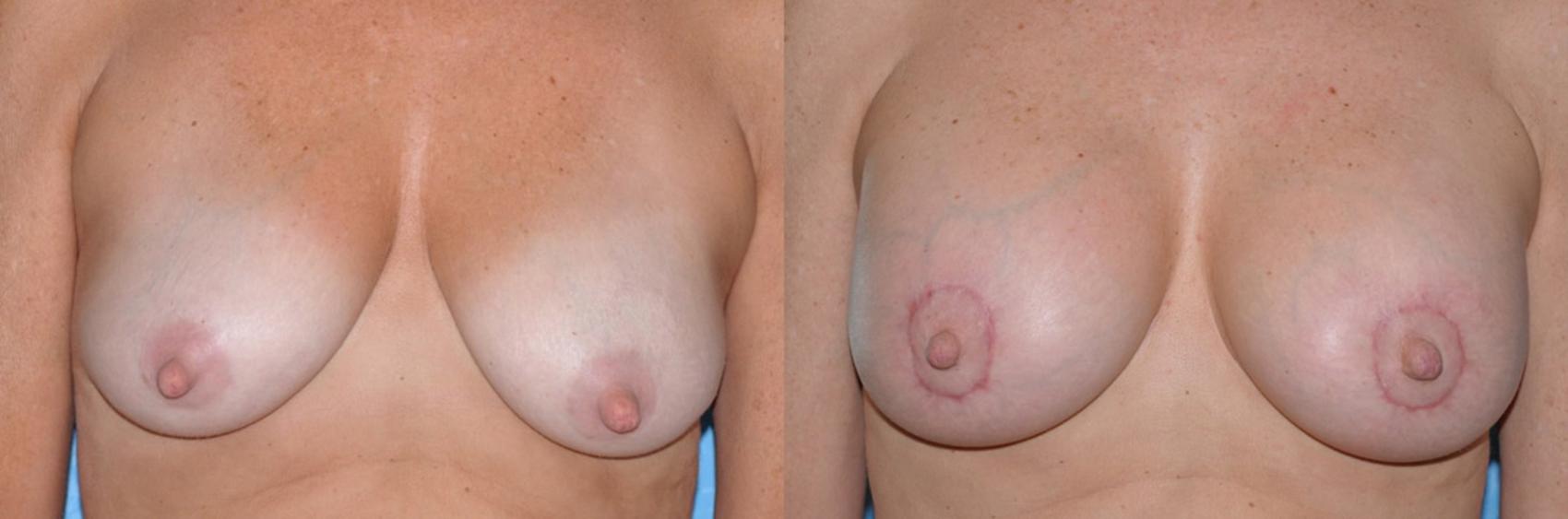 Before & After Breast Lift With Implants Case 47 View #1 View in Toledo, Ohio