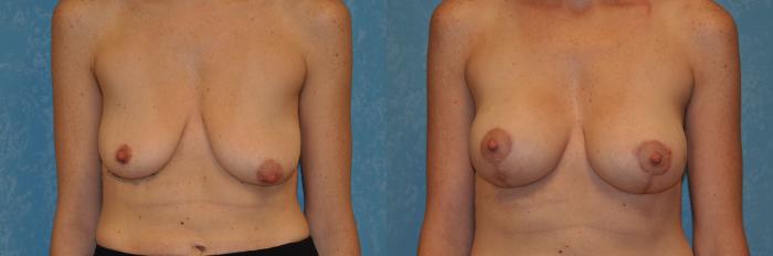 Before & After Breast Lift With Implants Case 471 Front View in Toledo, Ohio