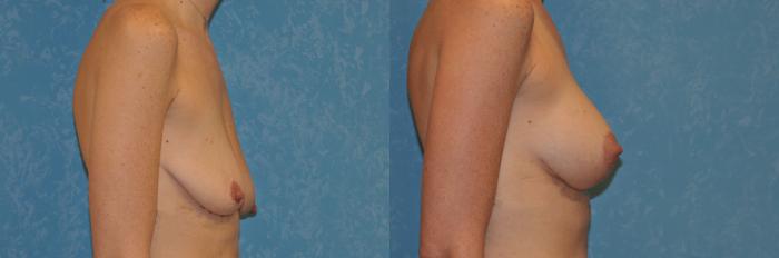 Before & After Breast Lift With Implants Case 471 Right Side View in Toledo, Ohio