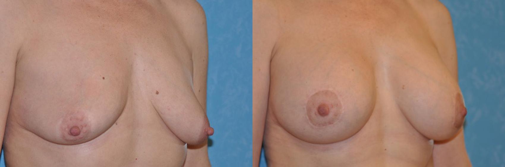 Before & After Breast Lift With Implants Case 48 View #1 View in Toledo, Ohio