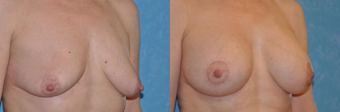 Before & After Breast Lift With Implants Case 48 View #1 View in Toledo, Ohio
