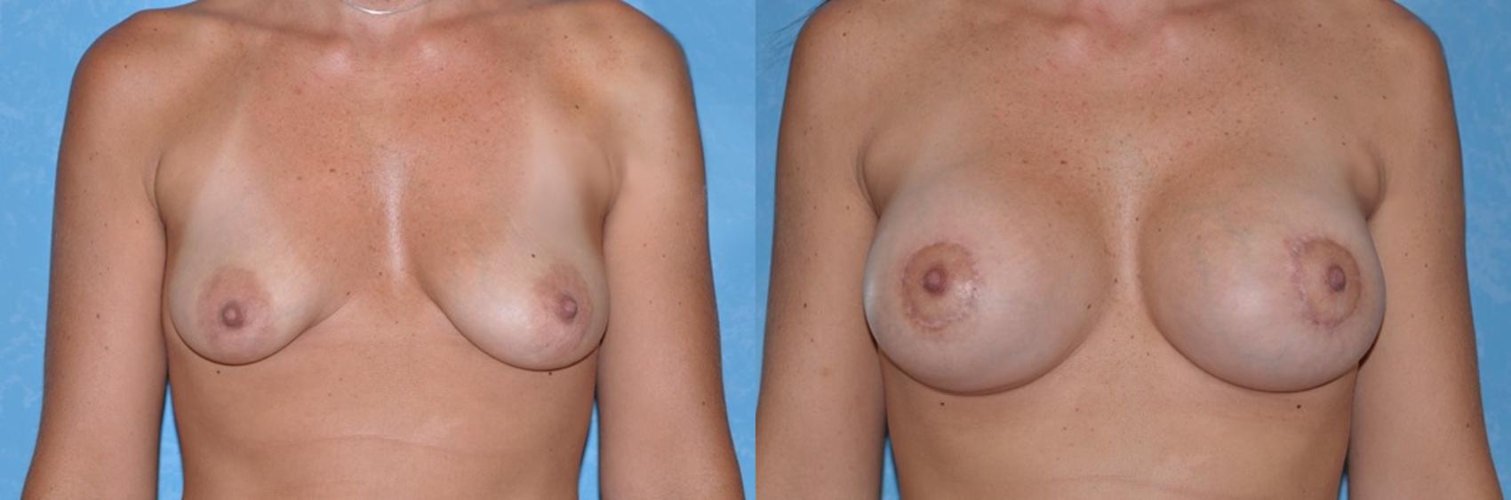 Before & After Breast Lift With Implants Case 49 View #1 View in Toledo, Ohio