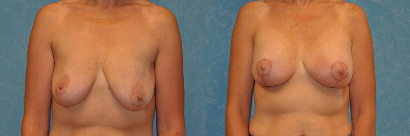 Before & After Breast Lift With Implants Case 507 Front View in Toledo, Ohio
