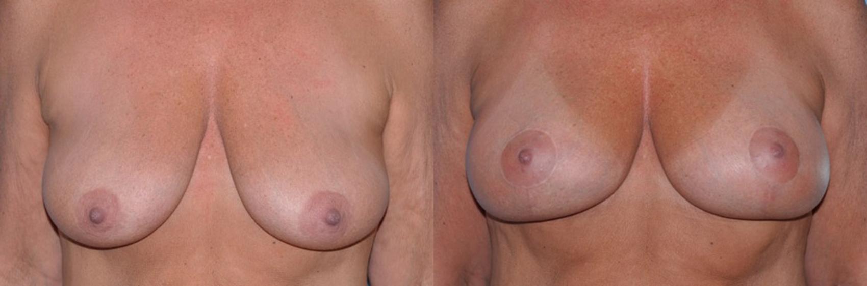Before & After Breast Lift With Implants Case 51 View #1 View in Toledo, Ohio