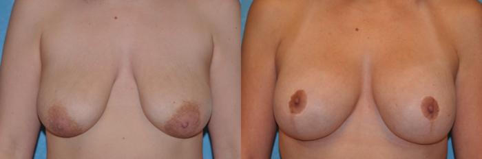 Before & After Breast Lift With Implants Case 536 Front View in Toledo, Ohio