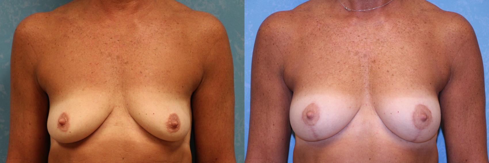 Before & After Breast Lift With Implants Case 543 Front View in Toledo, Ohio