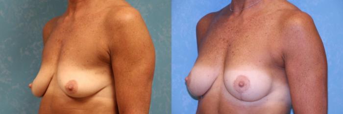 Before & After Breast Lift With Implants Case 543 Left Oblique View in Toledo, Ohio