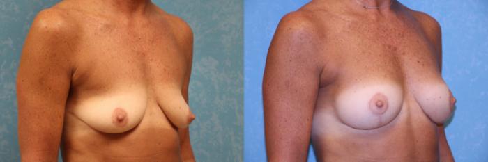 Before & After Breast Lift With Implants Case 543 Right Oblique View in Toledo, Ohio