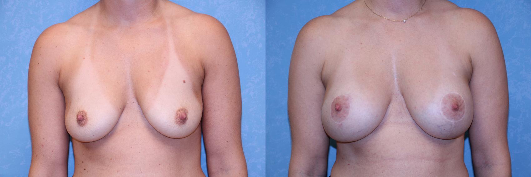 Before & After Breast Lift With Implants Case 553 Front View in Toledo, Ohio