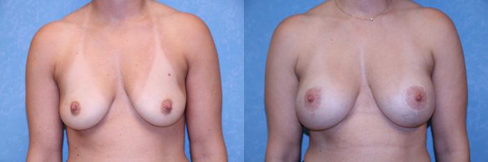 Before & After Breast Lift With Implants Case 553 Front View in Toledo, Ohio