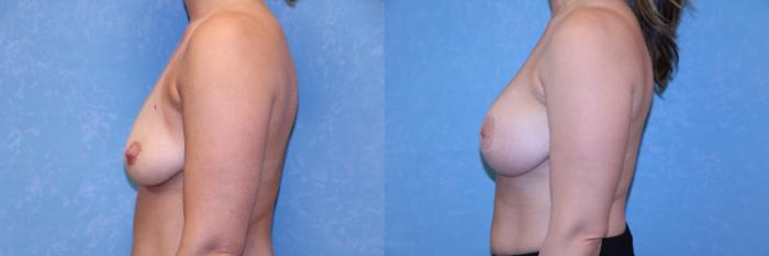 Before & After Breast Lift With Implants Case 553 Left Side View in Toledo, Ohio