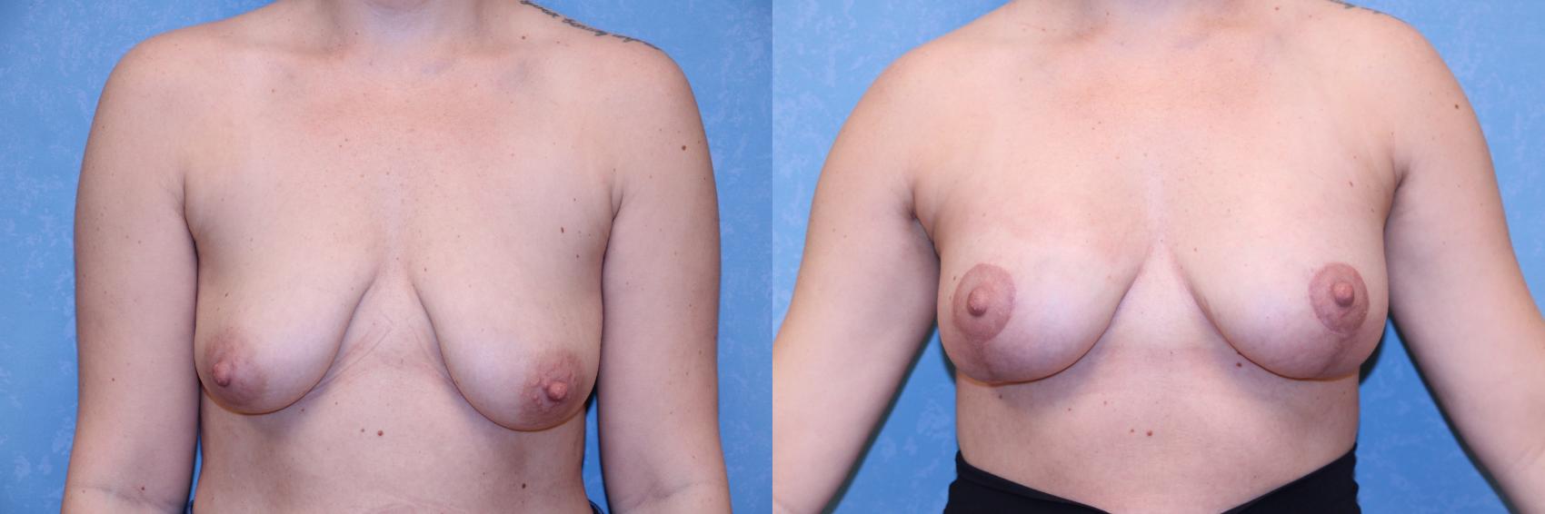 Before & After Breast Reduction Case 573 Front View in Toledo, Ohio
