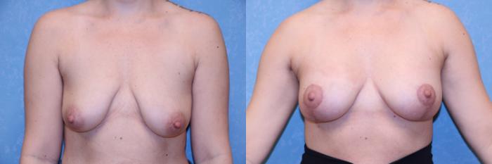 Before & After Breast Lift With Implants Case 573 Front View in Toledo, Ohio