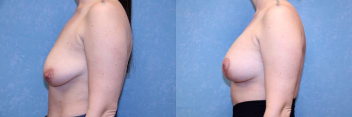 Before & After Breast Reduction Case 573 Left Side View in Toledo, Ohio