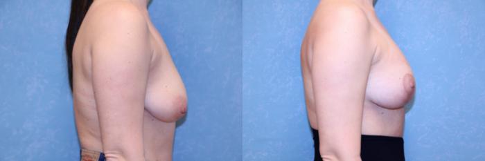 Before & After Breast Reduction Case 573 Right Side View in Toledo, Ohio