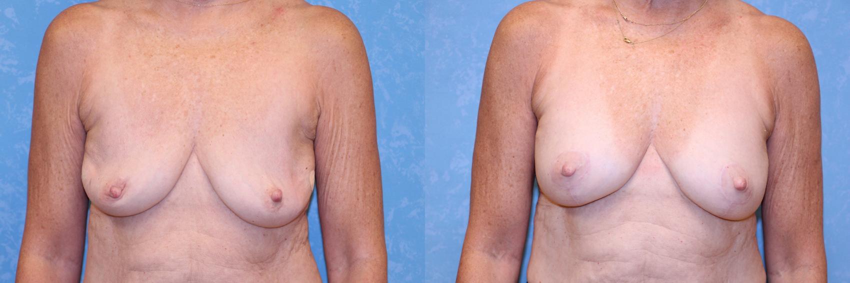Before & After Breast Lift With Implants Case 584 Front- deflation vs. post op View in Toledo, Ohio