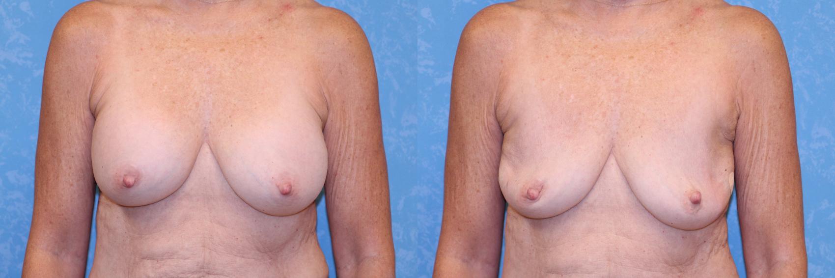 Saline implants pre deflation