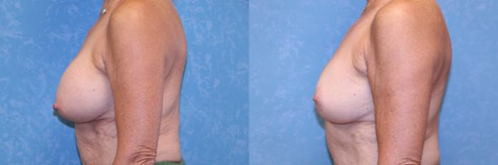 Before & After Breast Lift With Implants Case 584 Left Side View in Toledo, Ohio