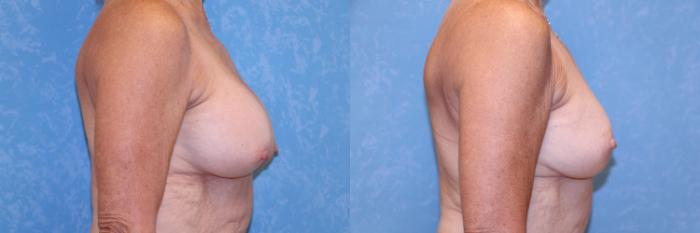 Before & After Breast Lift With Implants Case 584 Right Side View in Toledo, Ohio