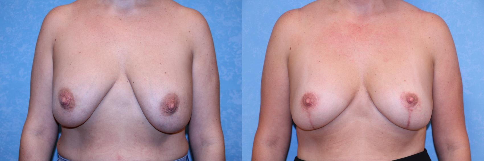 Before & After Breast Lift With Implants Case 587 Front View in Toledo, Ohio