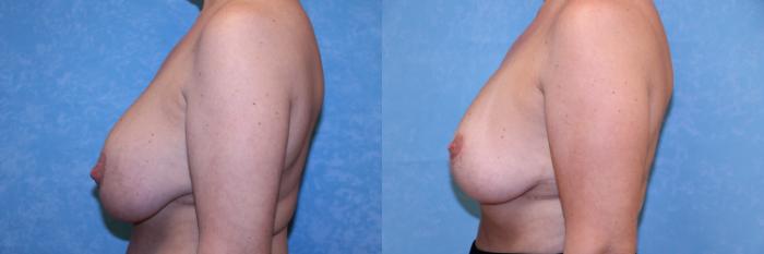 Before & After Breast Lift With Implants Case 587 Left Side View in Toledo, Ohio