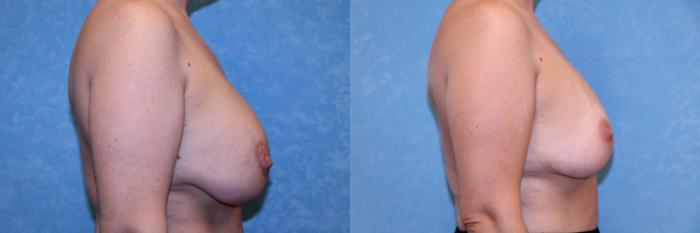 Before & After Breast Lift With Implants Case 587 Right Side View in Toledo, Ohio