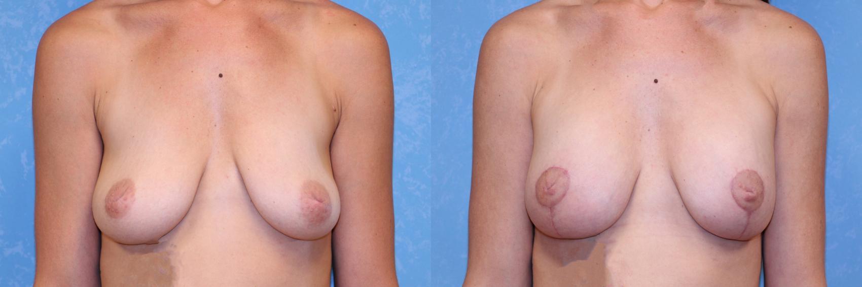 Before & After Breast Lift With Implants Case 588 Front View in Toledo, Ohio