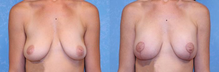 Before & After Breast Lift With Implants Case 588 Front View in Toledo, Ohio