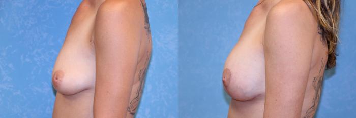 Before & After Breast Lift With Implants Case 588 Left Side View in Toledo, Ohio