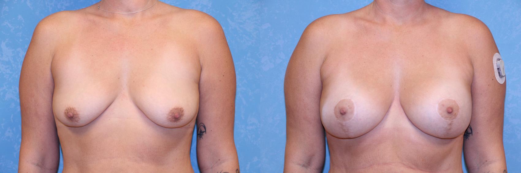 Before & After Breast Lift With Implants Case 598 Front View in Toledo, Ohio