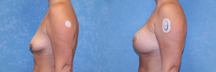 Before & After Breast Lift With Implants Case 598 Left Side View in Toledo, Ohio