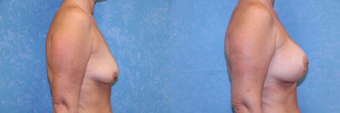 Before & After Breast Lift With Implants Case 598 Right Side View in Toledo, Ohio