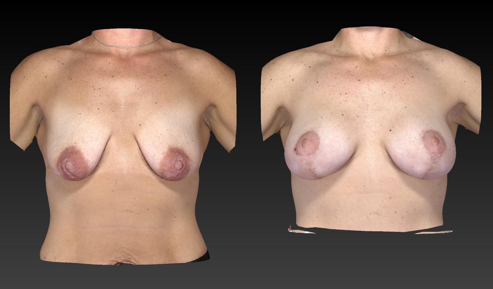 Before & After Breast Procedures Case 185 View #1 View in Toledo, Ohio